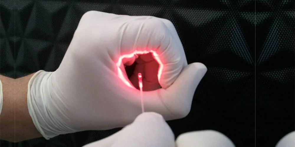 Laser na Coloproctologia